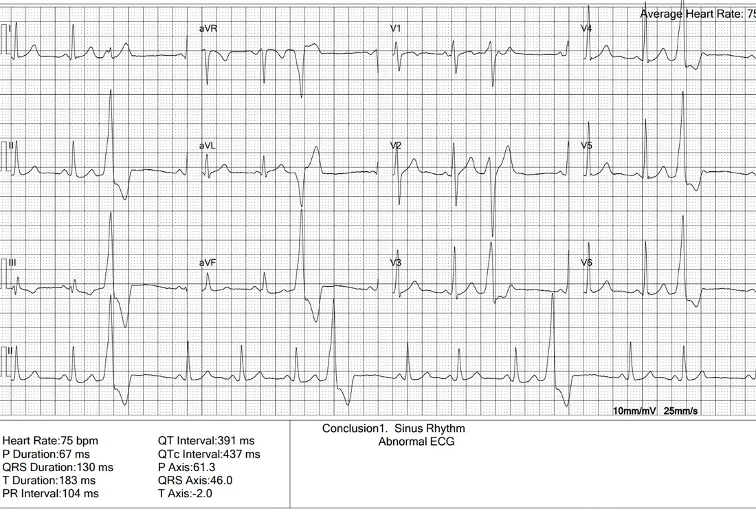 A 12-lead ECG report printed with the conclusion &ldquo;Sinus Rhythm, Abnormal ECG&rdquo;, showing frequent wide early beats (premature ventricular complexes, or PVCs) along the rhythm strip