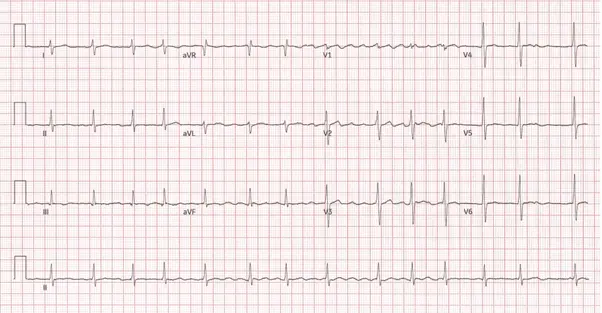 12-lead ECG of a patient with atrial fibrillation showing an irregular, fast ventricular response and the absence of distinct P waves